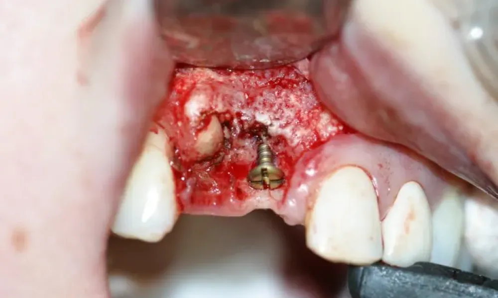 Clinical photo from Hope's smile reconstruction case